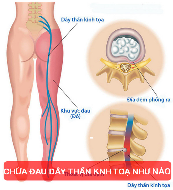 Chữa bệnh đau dây thần kinh tọa ở đâu hiệu quả? Cách chữa đau thần kinh tọa tại nhà