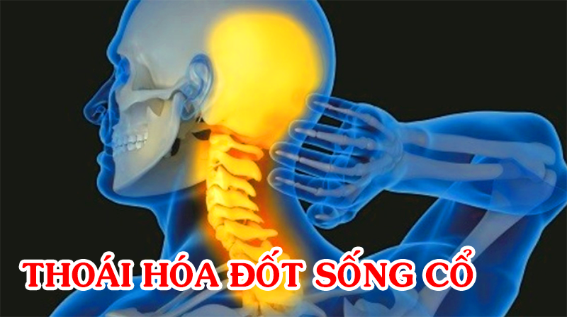 HỎI "Thoái hóa đốt sống cổ ở người trẻ tuổi phải làm sao?"