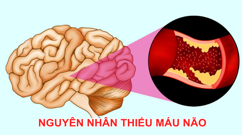 Nguyên nhân gây thiếu máu não