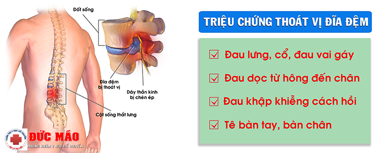 Triệu chứng thoát vị đĩa đệm - Tập Vật lý trị liệu thoát vị đĩa đệm TPHCM phòng khám Đức Mão