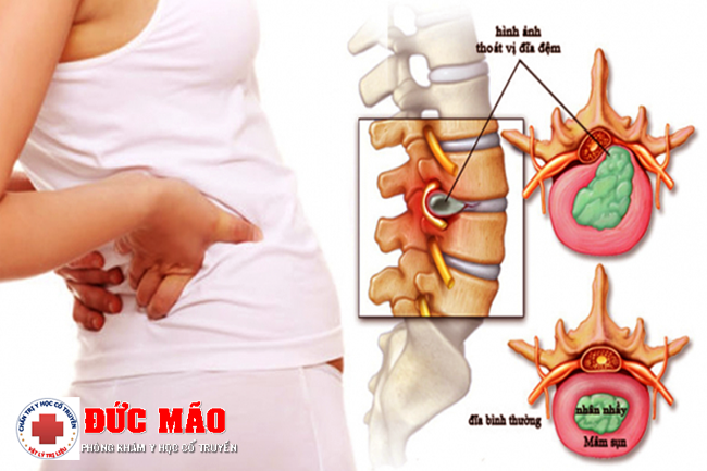 Người bị thoát vị đĩa đệm cần khám chữa và điều trị kịp thời - Tập Vật lý trị liệu thoát vị đĩa đệm TPHCM phòng khám Đức Mão