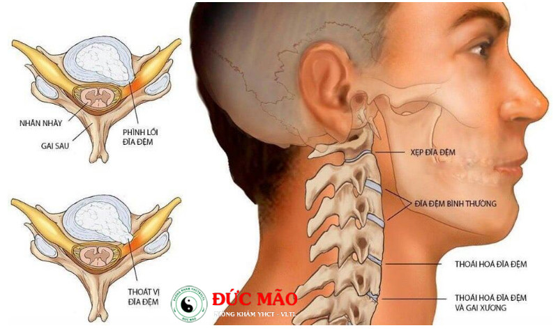 Thoát vị đĩa đệm cột sống cổ là bệnh gì?: Thoát vị đĩa đệm đốt sống cổ gây đau nhức do nhân nhầy chèn ép dây thần kinh