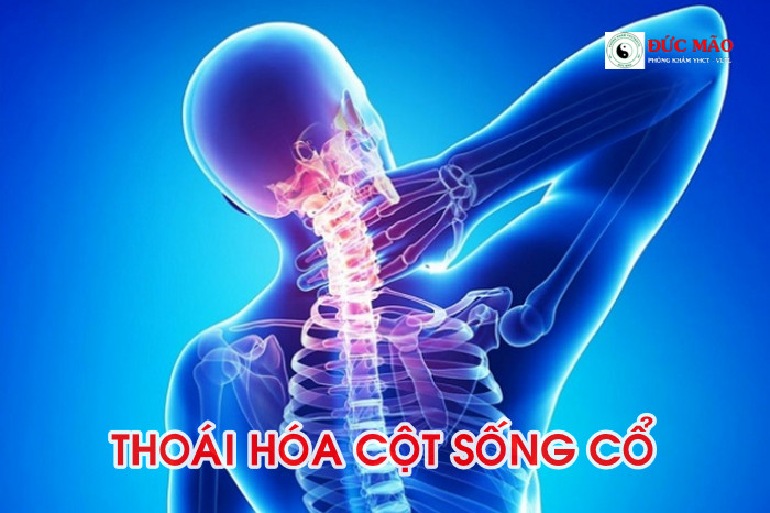 Ngủ dậy bị đau cổ phải làm sao? Nguyên nhân và cách đề phòng: Thoát vị đĩa đệm cột sống cổ có thể là nguyên nhân khiến đau mỏi đốt sống cổ