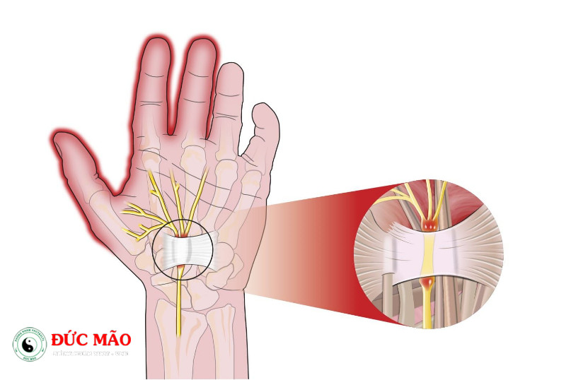 Hội chứng ống cổ tay là gì: Nguyên nhân chính của hội chứng ống cổ tay by Phòng khám Đức Mão