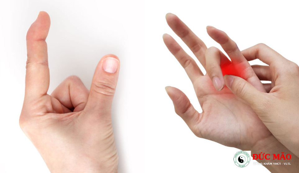 Nguyên nhân Bị hội chứng ngón tay cò súng: Phẫu thuật hay Vật lý trị liệu ngón tay cò súng. by Phòng Khám Đức Mão