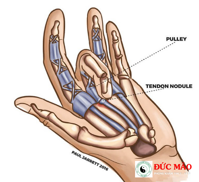 Dấu hiệu của hội chứng ngón tay cò súng (trigger finger) thường bắt đầu từ những triệu chứng nhẹ và dần dần trở nên rõ rệt hơn