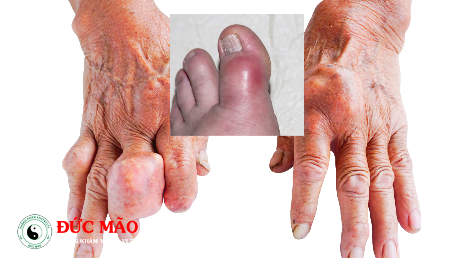 Đề phòng bệnh gout sớm để tránh biến chứng nặng